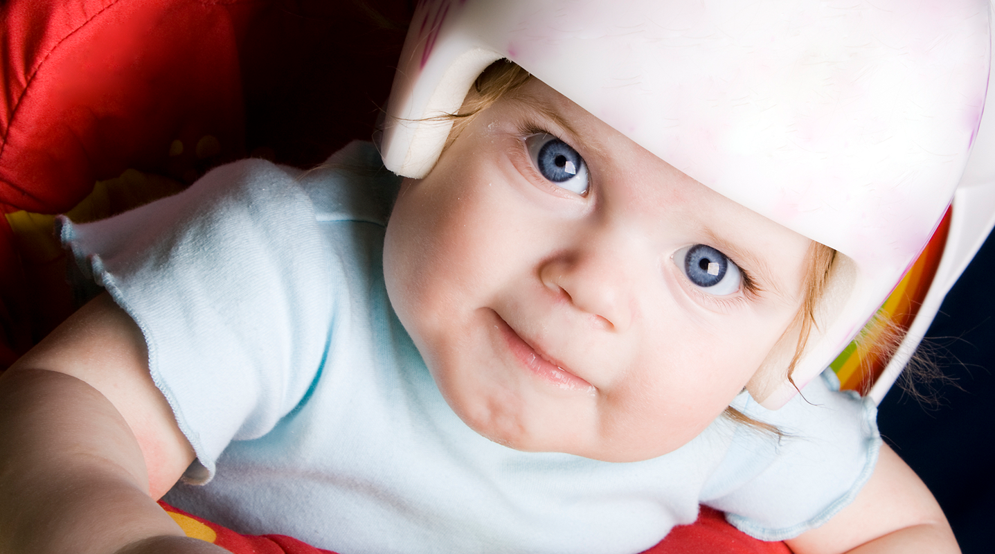 baby with plagiocephaly wearing helmet
