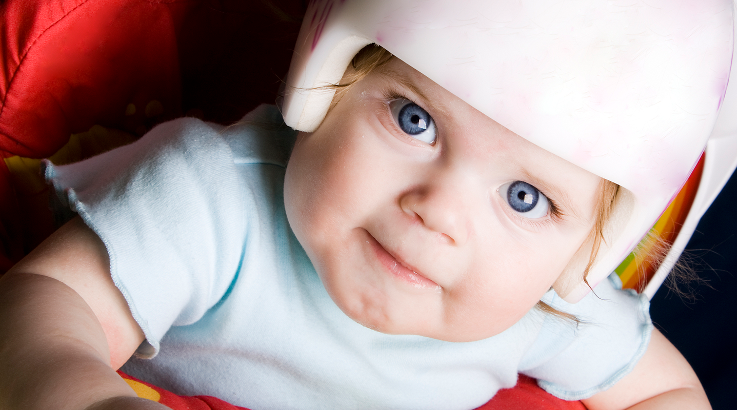 why do some babies wear helmets reddit