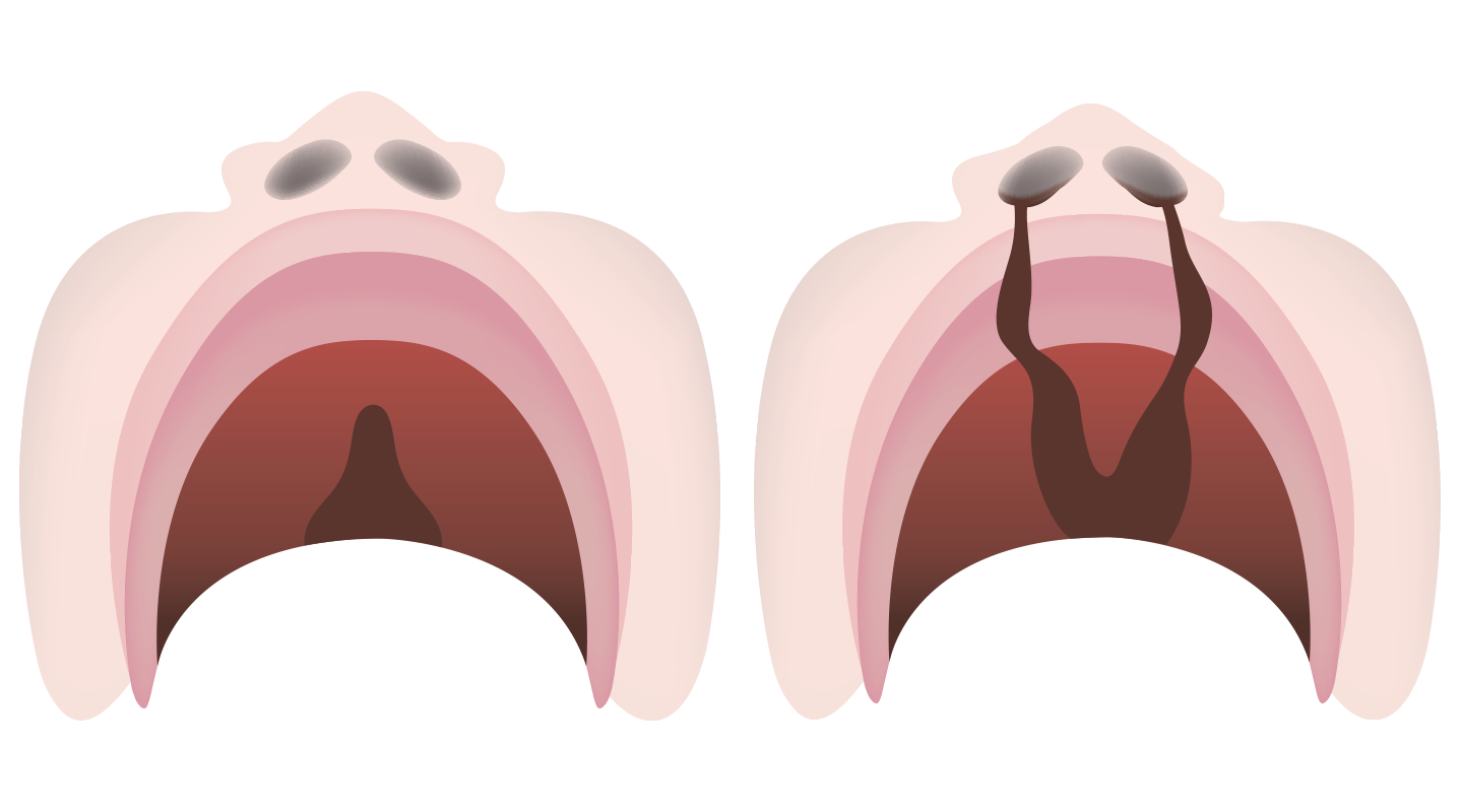 cleft palate full and bilateral illustration