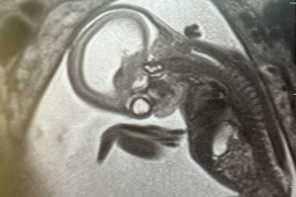 Casey's sonogram during 15-week prenatal screening